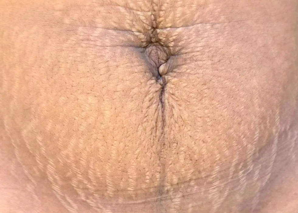 Before: abdomen with visible light stretch marks around the navel