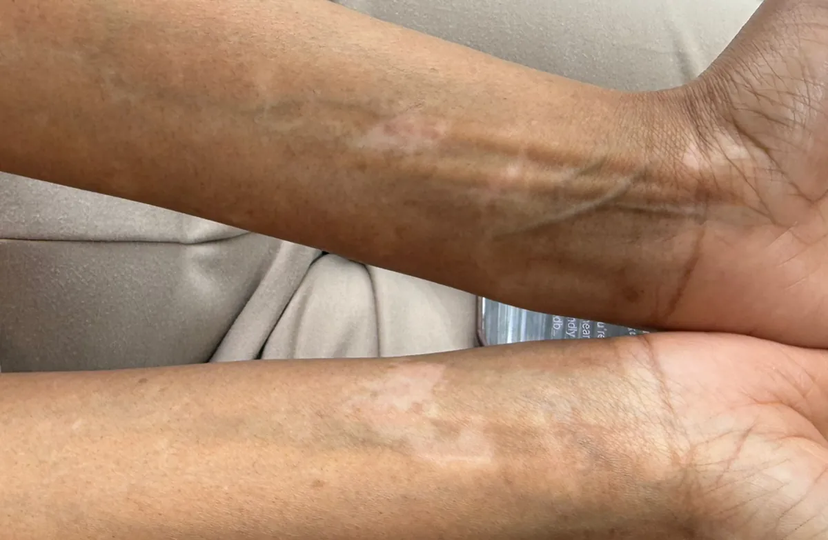 After: the same forearms with the patches softened and blended