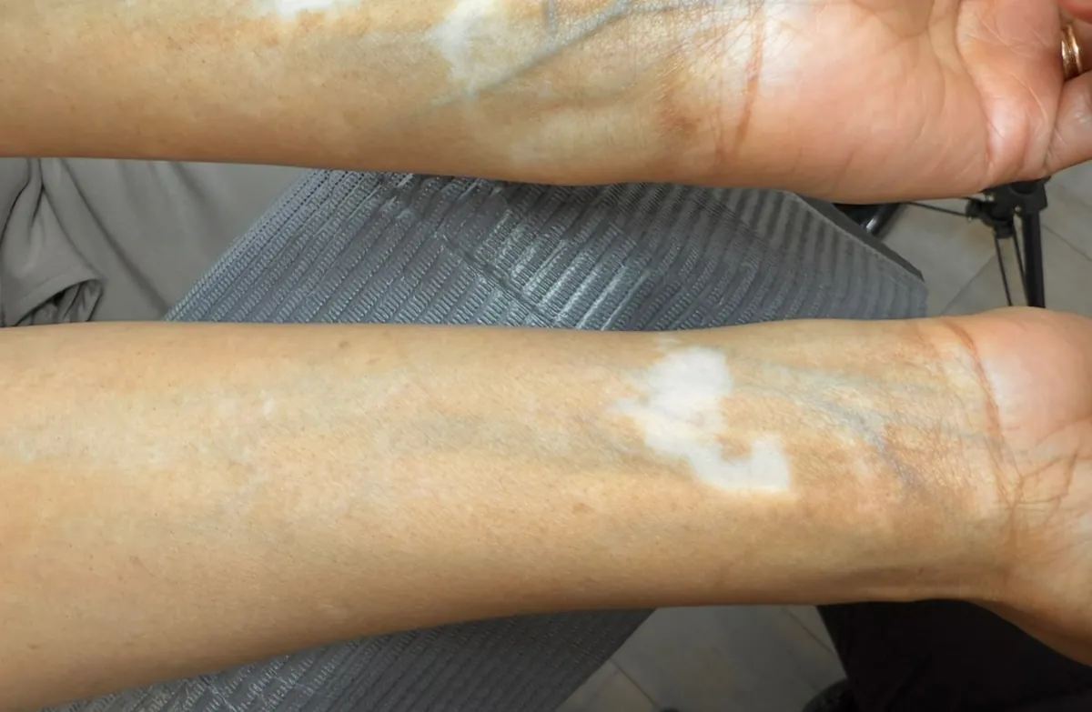 Before: forearms with light vitiligo patches