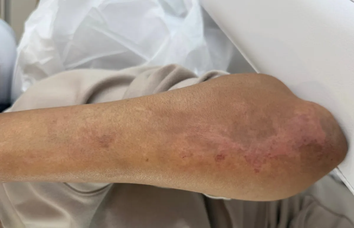 After: the same elbow with the patches blended toward the surrounding tone
