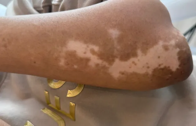 Before: elbow with lighter vitiligo patches