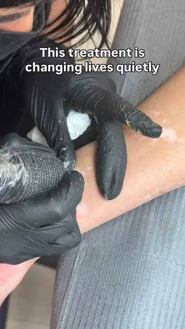 Scar camouflage in progress