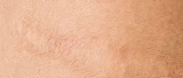 After: a light scar blended closer to the surrounding skin