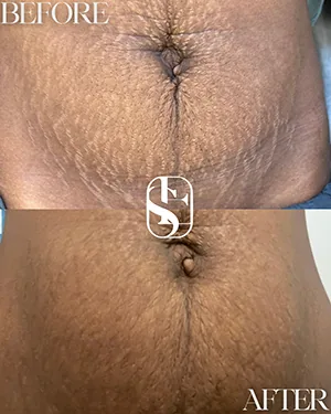 Before (top) and after (bottom): stretch marks around the navel