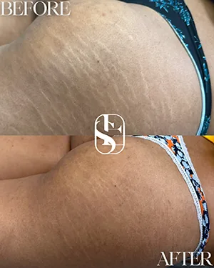 Before and after: stretch mark camouflage on the hip