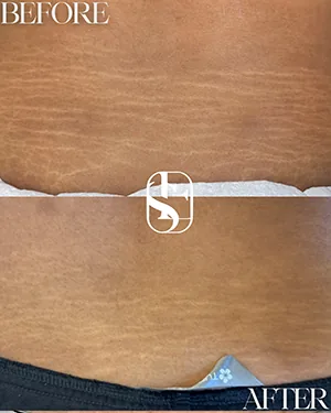 Before (top) and after (bottom): stretch marks on the lower abdomen