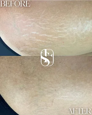Before and after: stretch mark camouflage on the thigh