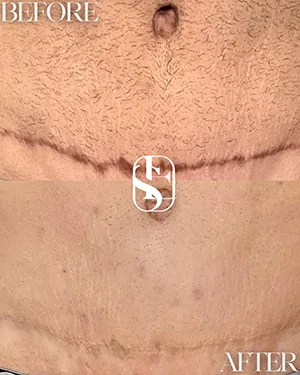 Before (top) and after (bottom): tummy tuck scar camouflage