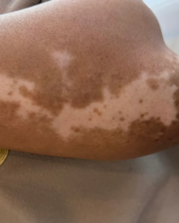 Vitiligo patches on darker skin before camouflage