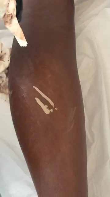 Stretch marks on calves: camouflage tattoo results (video still)
