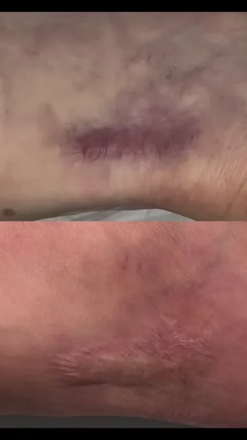 Dark scar camouflage tattoo after one session (video still)
