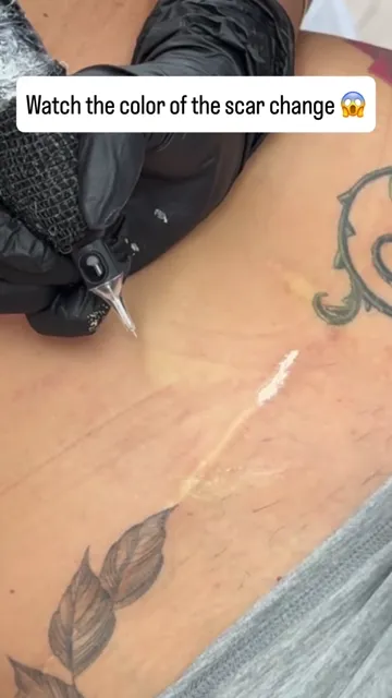 Hypopigmented scar camouflage tattoo explained (video still)