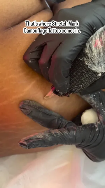 Stretch marks after weight loss: camouflage tattoo (video still)