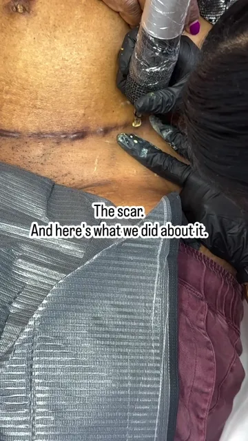 Tummy tuck scar camouflage tattoo (video still)