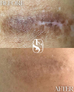 Healed Vitiligo & Discolouration camouflage result