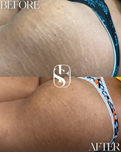 Healed C-Section Scar camouflage result
