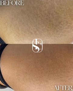 Healed Knee / Joint Scars camouflage result