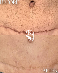 Healed Stretch Marks camouflage result
