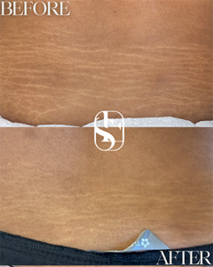 Healed Tummy Tuck Scar camouflage result