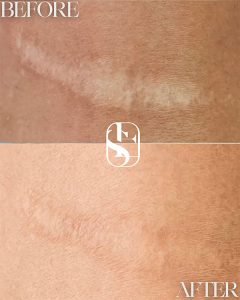 Healed Surgical Scar camouflage result