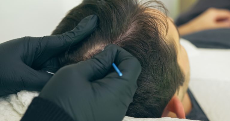All You Need To Know About Scalp Micropigmentation