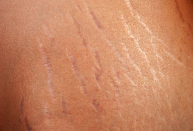 Should You Get A Tattoo Over Stretch Marks?
