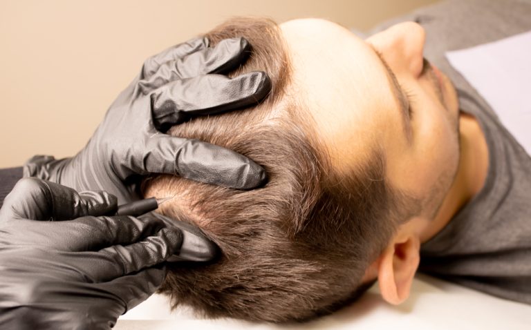 7 Common Mistakes When Getting Scalp Micropigmentation Done