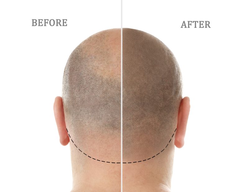 Ways To Make Your Scalp Look Thicker & Fuller After Scalp Micropigmentation