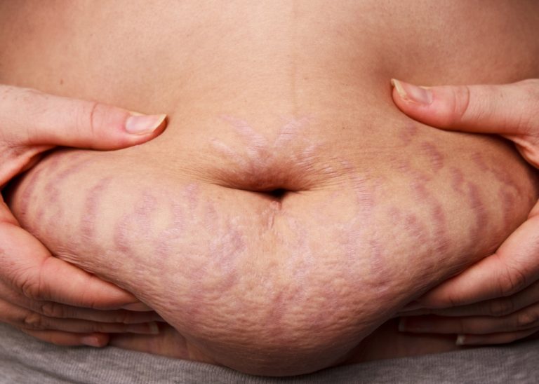 Worried About Stretch Marks On Your Shoulder? Check Out This Guide