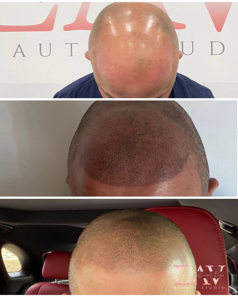 Scalp Micropigmentation Versus Hair Transplant – What Should You Choose?