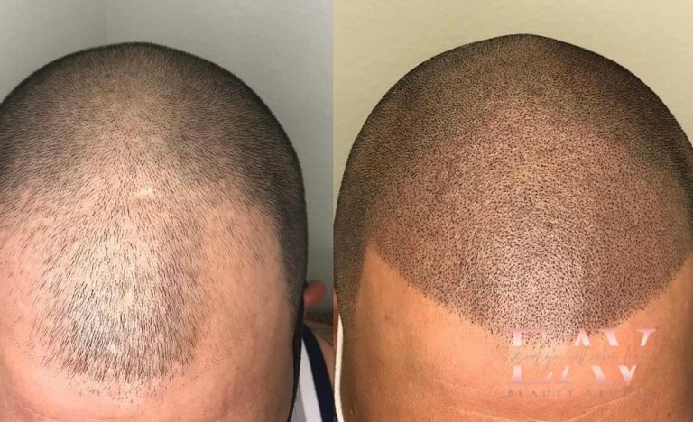 Is Scalp Micro-Pigmentation Worth It? Let Us Find Out