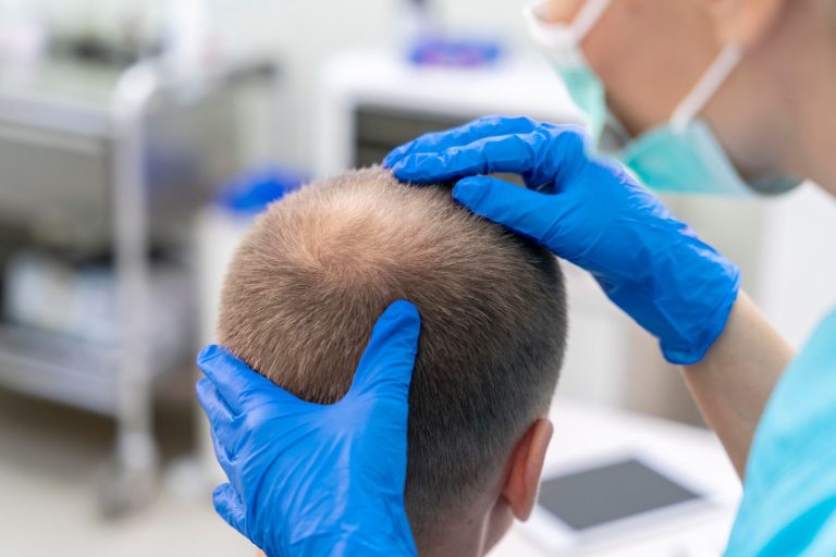 Scalp Micro Pigmentation