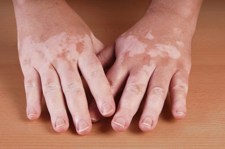 All You Need To Know About Treating Vitiligo Through Camouflage Tattoo Process
